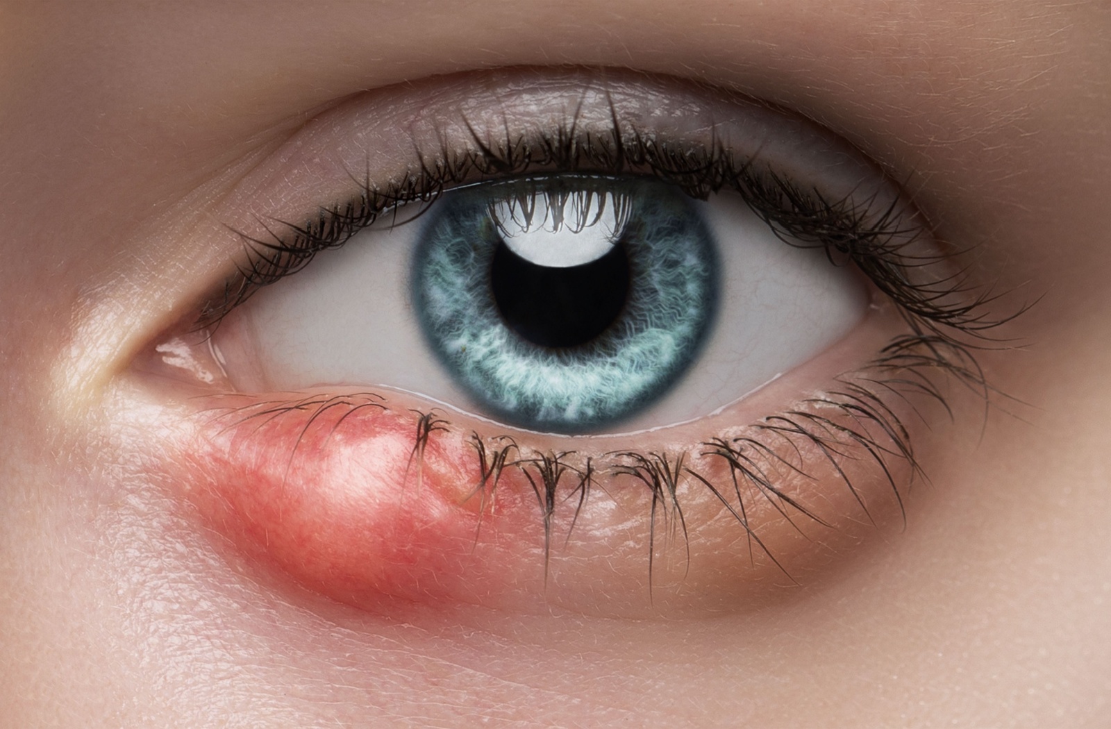 A person is diagnosed with a stye as per their eye care professional's opinion.